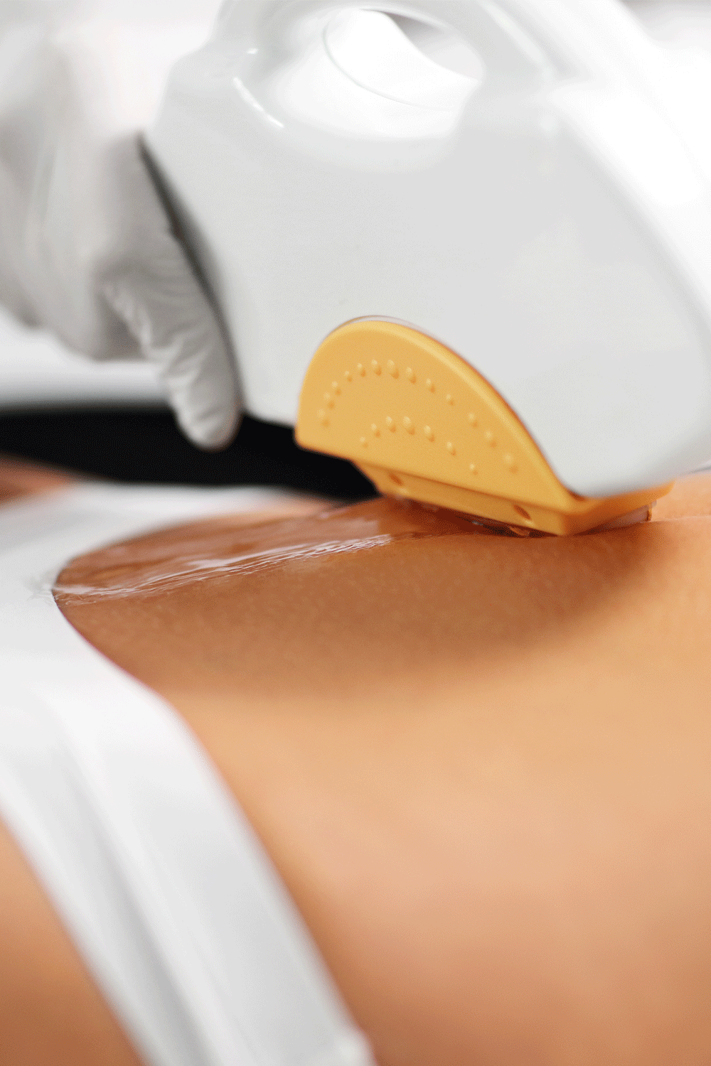 Bikini Abdominal Line